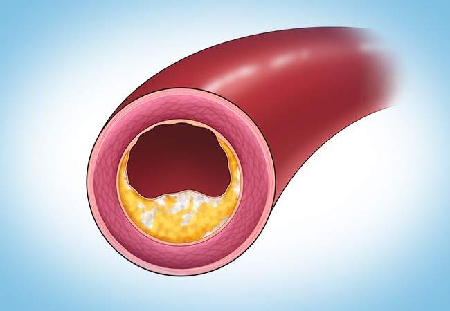 Coronary Artery Calcium Scoring Improves Accuracy of Cardiovascular Risk Screening